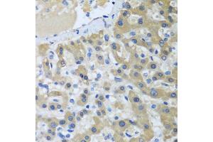 Immunohistochemistry of paraffin-embedded human liver cancer using XPC antibody. (XPC 抗体)