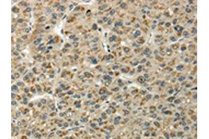 The image on the left is immunohistochemistry of paraffin-embedded Human liver cancer tissue using ABIN7128060(UBL4B Antibody) at dilution 1/25, on the right is treated with fusion protein. (UBL4B 抗体)