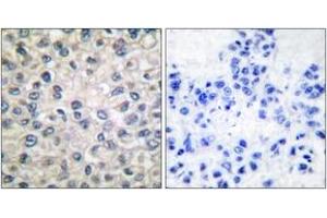 Immunohistochemistry analysis of paraffin-embedded human breast carcinoma tissue, using Catenin-alpha1 Antibody. (CTNNA1 抗体  (AA 857-906))