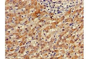 Immunohistochemistry of paraffin-embedded human liver cancer using ABIN7153223 at dilution of 1:100 (FUOM 抗体  (AA 1-134))