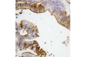 Anti-Annexin A2 antibody, IHC(P) IHC(P): Human Intestinal Cancer Tissue