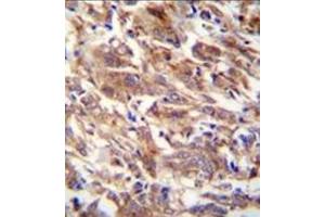 Immunohistochemistry analysis in formalin fixed and paraffin embedded human breast carcinoma reacted with FBXW12 Antibody (C-term) followed by peroxidase conjugation of the secondary antibody and DAB staining. (FBXW12 抗体  (C-Term))