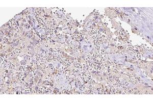 ABIN6273308 at 1/100 staining Human thyroid cancer tissue by IHC-P.