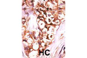 Formalin-fixed and paraffin-embedded human hepatocellular carcinoma tissue reacted with DUSP8 polyclonal antibody  , which was peroxidase-conjugated to the secondary antibody, followed by AEC staining. (DUSP8 抗体  (C-Term))