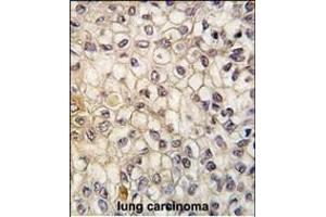 Formalin-fixed and paraffin-embedded human lung carcinoma tissue reacted with CYP2F1 antibody (C-term), which was peroxidase-conjugated to the secondary antibody, followed by DAB staining. (CYP2F1 抗体  (C-Term))