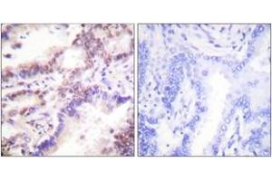 Immunohistochemistry analysis of paraffin-embedded human lung carcinoma tissue, using CTIP (Ab-327) Antibody. (Retinoblastoma Binding Protein 8 抗体  (AA 293-342))