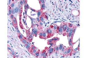 Anti-FZD4 / Frizzled 4 antibody IHC of human Pancreas, Carcinoma. (FZD4 抗体  (N-Term))