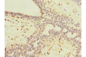 Immunohistochemistry of paraffin-embedded human breast cancer using ABIN7168420 at dilution of 1:100 (ROPN1L 抗体  (AA 1-230))