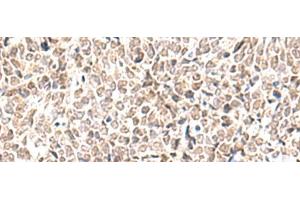 Immunohistochemistry of paraffin-embedded Human lung cancer tissue using EWSR1 Polyclonal Antibody at dilution of 1:70(x200) (EWSR1 抗体)