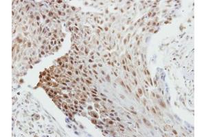 IHC-P Image Immunohistochemical analysis of paraffin-embedded human breast cancer, using Bcl-2, antibody at 1:250 dilution. (Bcl-2 抗体  (N-Term))