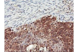 Immunohistochemical staining of paraffin-embedded Adenocarcinoma of Human ovary tissue using anti-NLN mouse monoclonal antibody. (NLN 抗体)