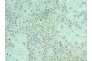 Immunohistochemistry of paraffin-embedded human breast cancer using ABIN7143956 at dilution of 1:100 (ALS2 抗体  (AA 1-280))