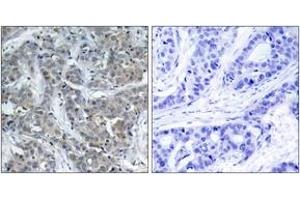Immunohistochemistry analysis of paraffin-embedded human breast carcinoma tissue, using Stathmin 1 (Ab-15) Antibody. (Stathmin 1 抗体  (AA 5-54))