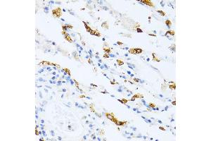 Immunohistochemistry of paraffin-embedded human lung cancer using SFTPC antibody. (Surfactant Protein C 抗体)