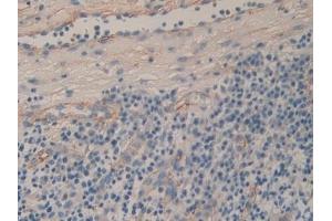 Detection of CD90 in Human Skin cancer Tissue using Polyclonal Antibody to Cluster of Differentiation 90 (CD90)