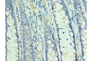 Immunohistochemistry of paraffin-embedded human colon cancer using ABIN7160232 at dilution of 1:100 (SMAD3 抗体  (AA 1-230))