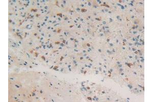 IHC-P analysis of Human Glioma Tissue, with DAB staining. (Coronin 1a 抗体  (AA 7-204))