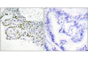 Immunohistochemistry analysis of paraffin-embedded human lung carcinoma, using PKC delta (Phospho-Tyr52) Antibody. (PKC delta 抗体  (pTyr52))