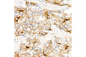 Immunohistochemistry (IHC) image for anti-Carcinoembryonic Antigen-Related Cell Adhesion Molecule 5 (CEACAM5) antibody (ABIN7266084)