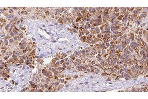 ABIN6273147 at 1/100 staining Human Melanoma tissue by IHC-P. (Osteocalcin 抗体  (Internal Region))