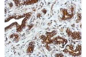 IHC-P Image Immunohistochemical analysis of paraffin-embedded human breast cancer, using Glycine Receptor alpha 2, antibody at 1:750 dilution. (GLRa2 抗体)