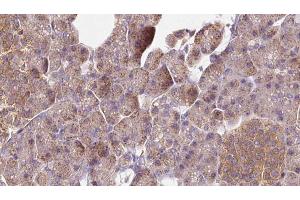 ABIN6273276 at 1/100 staining Human pancreas cancer tissue by IHC-P. (NSDHL 抗体  (Internal Region))