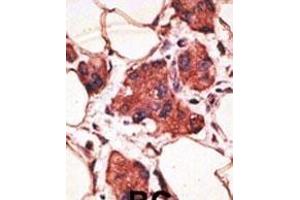 Formalin-fixed and paraffin-embedded human cancer tissue reacted with the primary antibody, which was peroxidase-conjugated to the secondary antibody, followed by AEC staining. (MAGEA9 抗体  (AA 171-198))