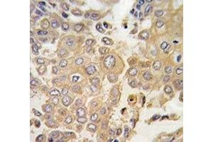 IHC analysis of FFPE human lung carcinoma tissue stained with MAPK4 antibody (MAPK4 抗体  (AA 72-101))