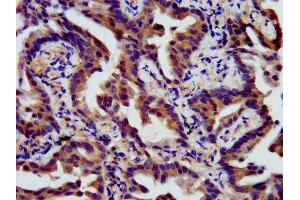 IHC image of ABIN7165980 diluted at 1:400 and staining in paraffin-embedded human lung cancer performed on a Leica BondTM system. (SSH3 抗体  (AA 480-659))