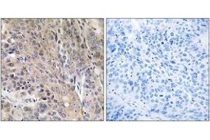 Immunohistochemistry analysis of paraffin-embedded human lung carcinoma, using LAMP3 Antibody. (LAMP3 抗体  (AA 274-323))