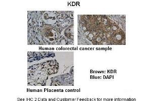 Researcher: Department of Pathology, Hospital de Carabineros de Chile, Santiago, ChileApplication: IHCSpecies+tissue/cell type: Control-Human Placenta, Sample-Human colorectal cancer Primary Antibody dilution: 1:100Secondary Antibody: Biotinylated pig anti-rabbit+streptavidin-HRP (VEGFR2/CD309 抗体  (N-Term))