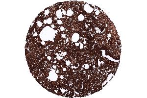 Pancreatic ductal adenocarcinoma with strong CA19 9 staining of all tumor cells (CA 19-9 抗体)