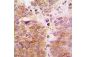 Immunohistochemical analysis of TAK1 staining in human breast cancer formalin fixed paraffin embedded tissue section. (TR4 抗体  (Center))