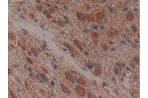 Detection of APOA1BP in Human Glioma Tissue using Polyclonal Antibody to Apolipoprotein A1 Binding Protein (APOA1BP) (APOA1BP 抗体  (AA 118-282))