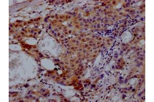 IHC image of ABIN7127867 diluted at 1:100 and staining in paraffin-embedded human breast cancer performed on a Leica BondTM system. (Recombinant VCP 抗体)