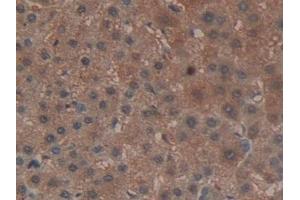 Detection of GPX4 in Human Liver cancer Tissue using Polyclonal Antibody to Glutathione Peroxidase 4 (GPX4)