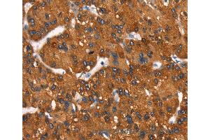 Immunohistochemistry of Human gastric cancer using MT-CYB Polyclonal Antibody at dilution of 1:50 (Cytochrome b 抗体)