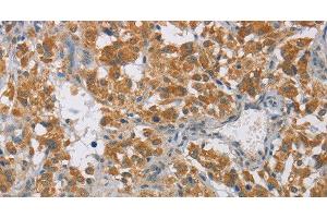 Immunohistochemistry of paraffin-embedded Human thyroid cancer tissue using DIO1 Polyclonal Antibody at dilution 1:60 (DIO1 抗体)