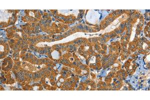 Immunohistochemistry of paraffin-embedded Human thyroid cancer tissue using EPHB3 Polyclonal Antibody at dilution 1:40 (EPH Receptor B3 抗体)