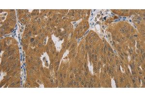 Immunohistochemistry of paraffin-embedded Human ovarian cancer using NIT2 Polyclonal Antibody at dilution of 1:40 (NIT2 抗体)