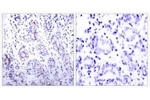 Immunohistochemical analysis of paraffin-embedded human breast carcinoma tissue using STAT3 (Ab-727) antibody (E021046). (STAT3 抗体)