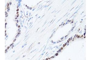 Immunohistochemistry of paraffin-embedded human colon carcinoma using SQSTM1 antibody. (SQSTM1 抗体  (AA 1-440))