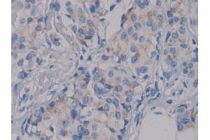 Detection of NPHN in Human Breast cancer Tissue using Polyclonal Antibody to Nephrin (NPHN) (Nephrin 抗体  (AA 23-92))