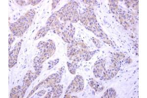 IHC-P Image PIGK antibody [N1C2] detects PIGK protein at cytosol on human breast carcinoma by immunohistochemical analysis. (PIGK 抗体)