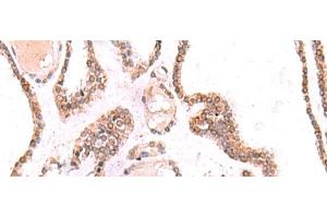 Immunohistochemistry of paraffin-embedded Human thyroid cancer tissue using TOR1AIP1 Polyclonal Antibody at dilution of 1:70(x200) (TOR1AIP1 抗体)