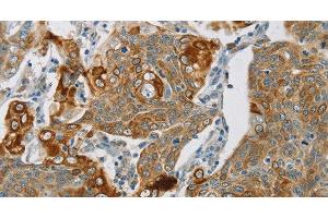 Immunohistochemistry of paraffin-embedded Human cervical cancer using SMOC2 Polyclonal Antibody at dilution of 1:30