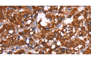 Immunohistochemistry of paraffin-embedded Human thyroid cancer tissue using GAGE12I Polyclonal Antibody at dilution 1:30 (G Antigen 12I 抗体)