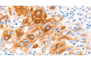 Immunohistochemistry of paraffin-embedded Human cervical cancer tissue using SLC2A11 Polyclonal Antibody at dilution 1:140 (SLC2A11 抗体)