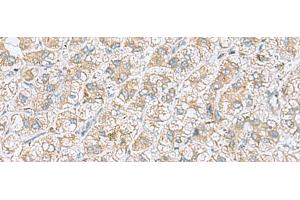 Immunohistochemistry of paraffin-embedded Human liver cancer tissue using NDRG4 Polyclonal Antibody at dilution of 1:45(x200) (NDRG4 抗体)