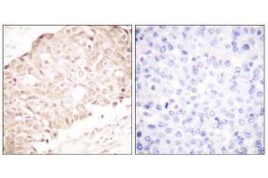 Immunohistochemistry analysis of paraffin-embedded human breast carcinoma tissue using SENP1 antibody. (SENP1 抗体  (N-Term))